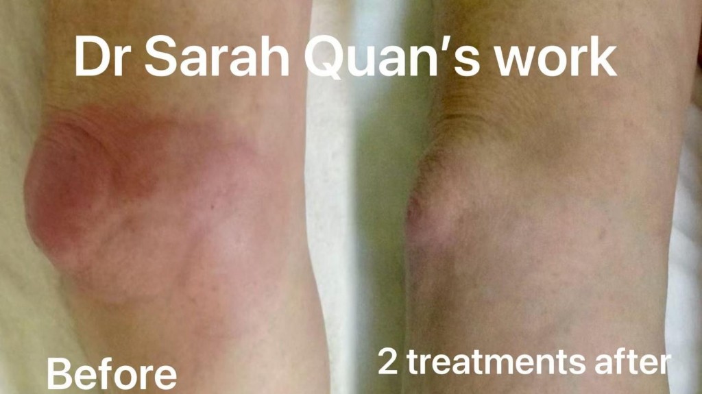 Gout treatment before and after two acupuncture treatments