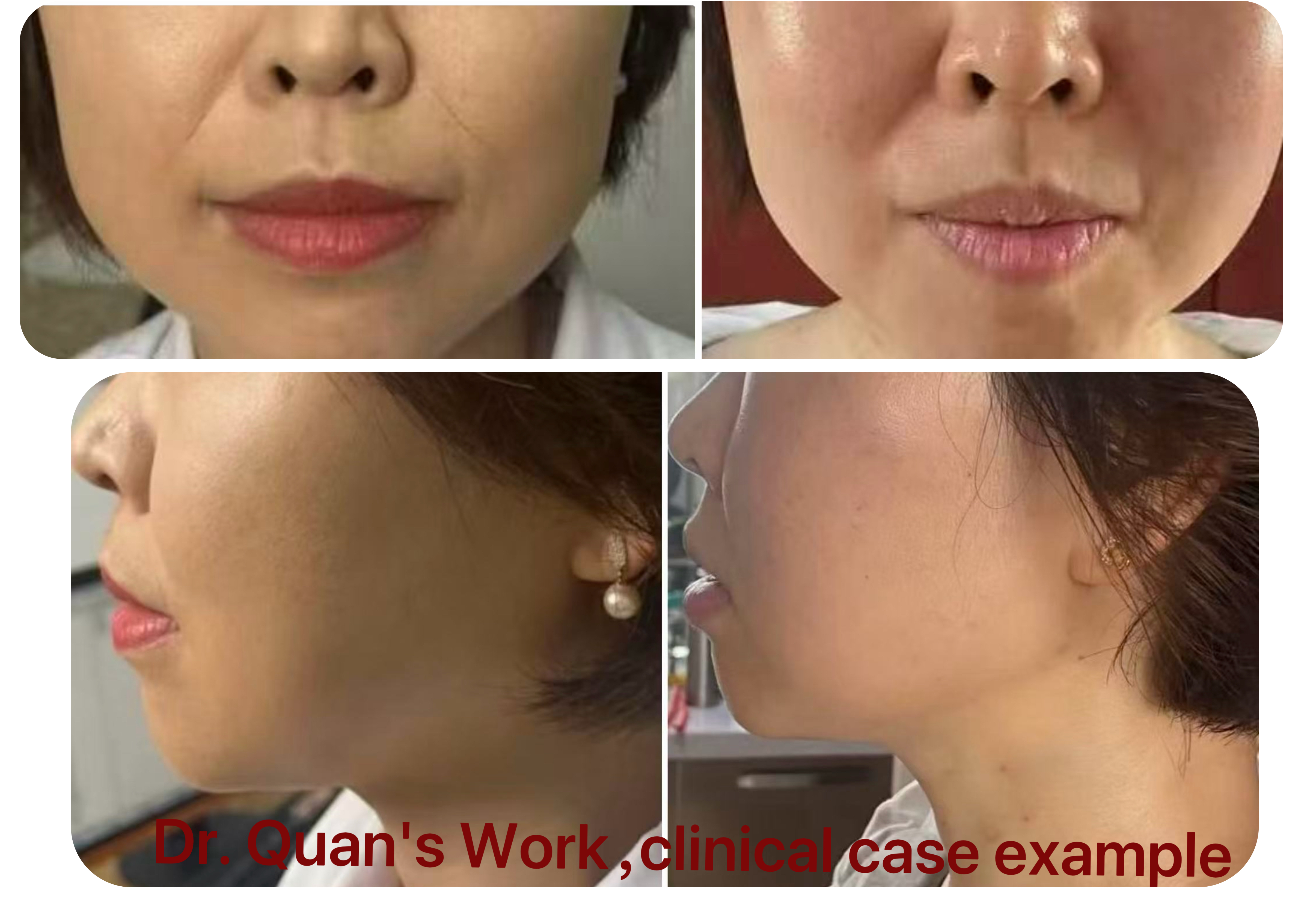 Facial Sculpting Acupuncture clinical case example — neck and face, photo 1