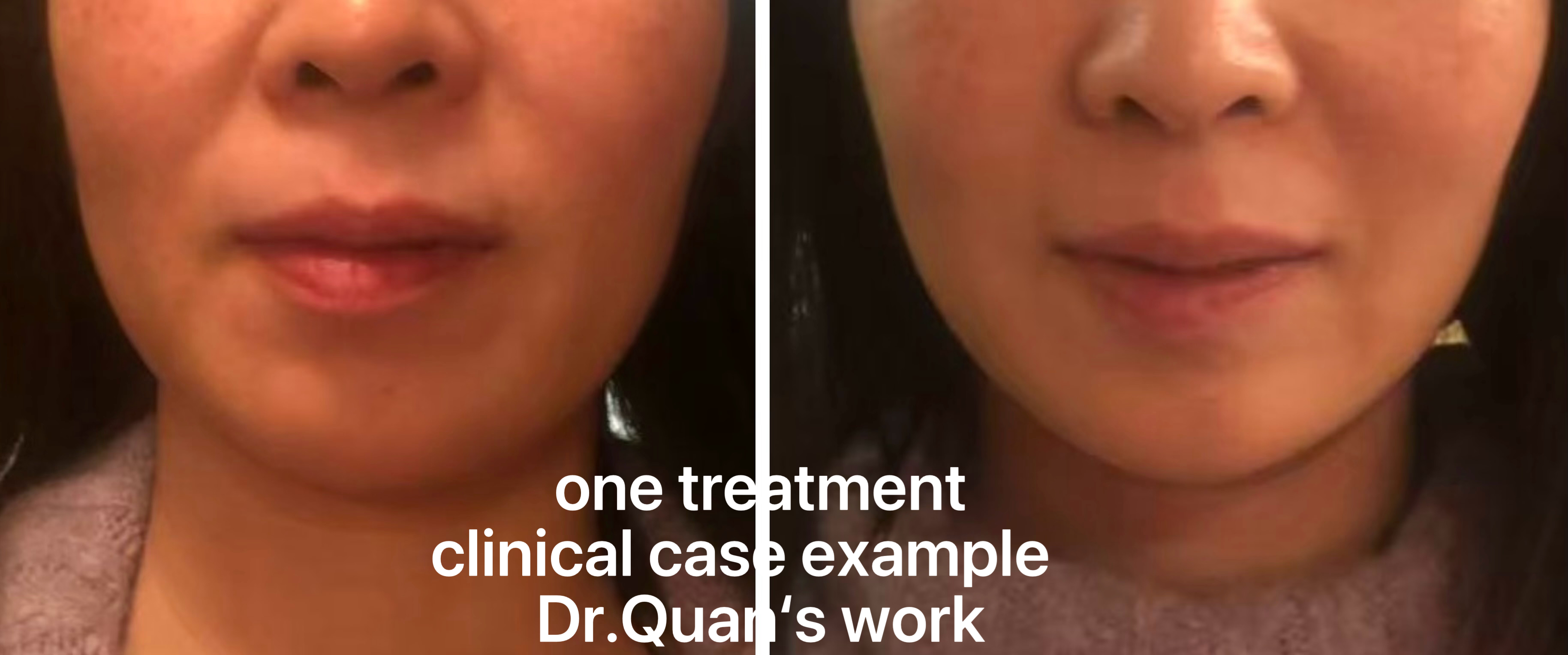 Facial Sculpting Acupuncture clinical case example — neck and face, photo 3