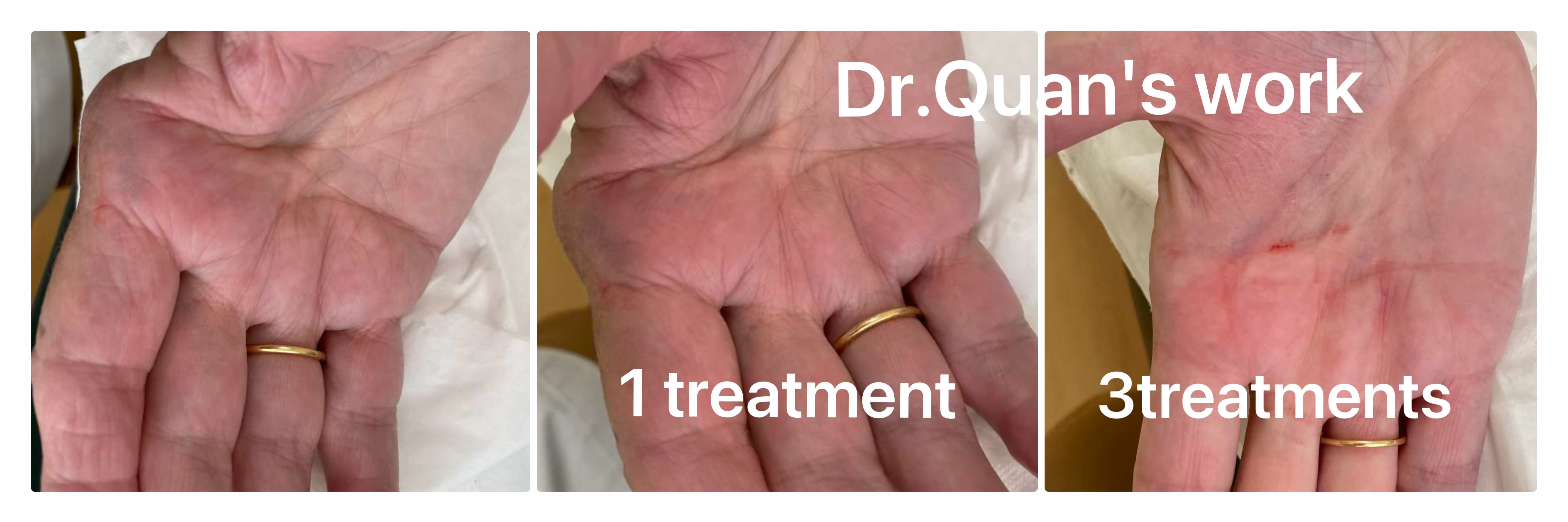 Osteoarthritis patient story